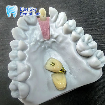 खरीदें एकल प्रत्यारोपण मुकुट के साथ परिशुद्धता पीस Zirconia Abutment online manufacture
