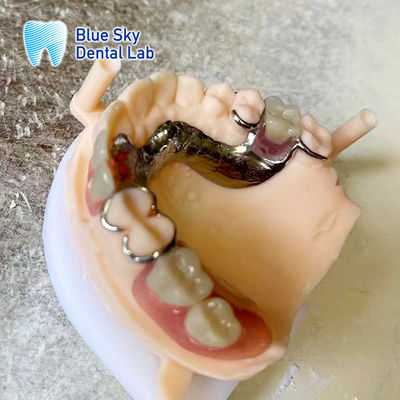 धातु फ्रेम के साथ हल्के ऐक्रेलिक राल आंशिक प्रोटेक्ट